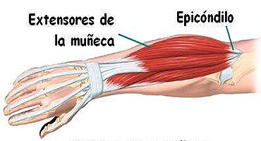 Cómo identificar la Epicondilitis