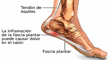 ¿Qué es la fascia plantar y qué es una fascitis plantar?