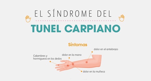 ¿Qué es el síndrome del túnel carpiano?