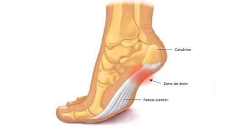 Fascitis plantar, una lesión muy común entre los jugadores